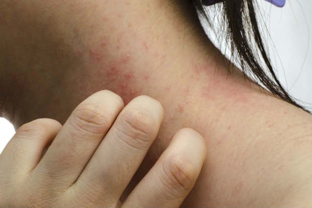  Temperaturas mais quentes contribuem para crescimento de dermatites