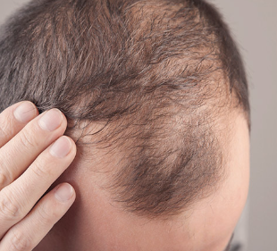  Estresse é uma das principais causas da alopecia
