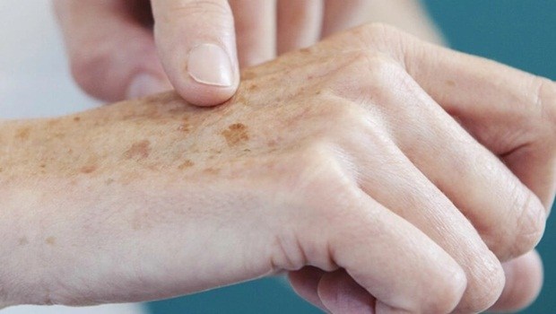  Mutirão atende pacientes com lesões suspeitas de câncer de pele
